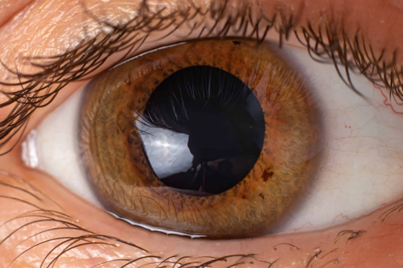 Cornea Issues