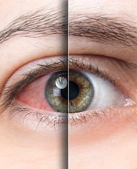 Dry Eye Evaluation in Orchard Park NY