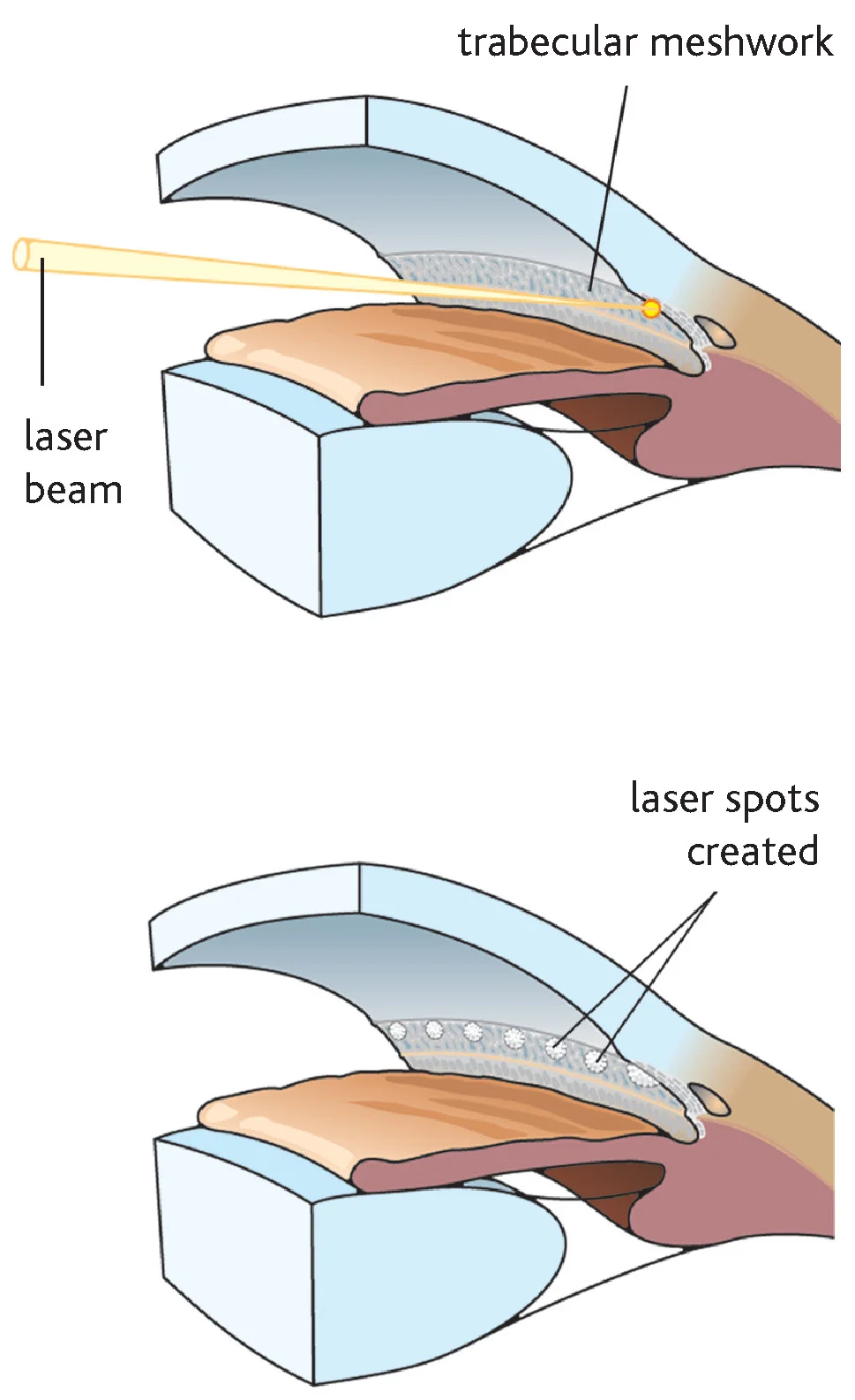 Trabeculoplasty