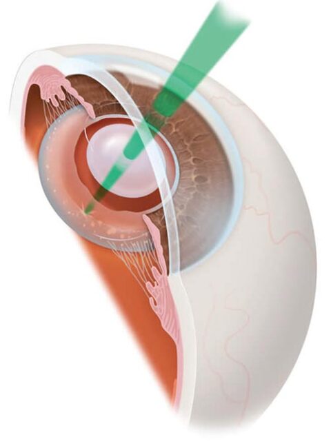 YAG-Capsulotomy-Procedure-Orchard Park NY