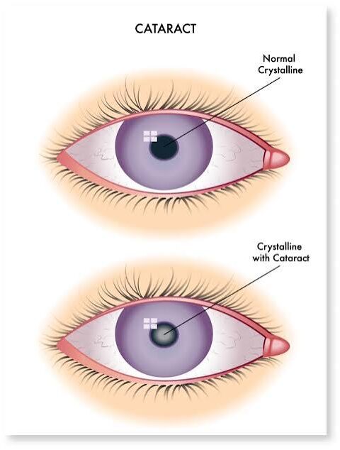 age related cataract