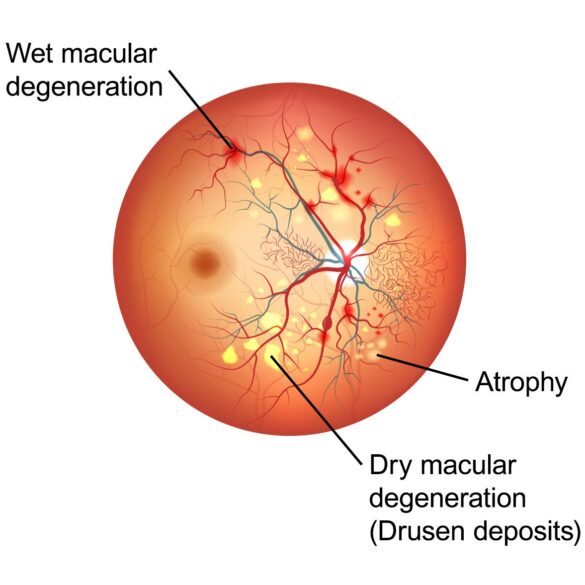Wet Macular degeneration