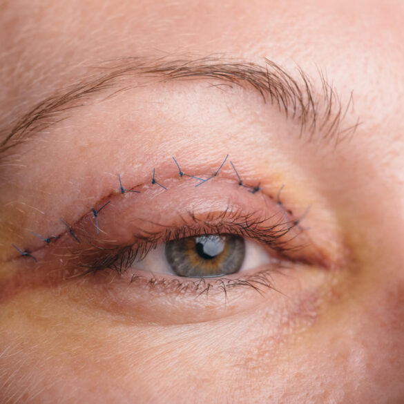 Eyelid surgery near Orchard Park NY