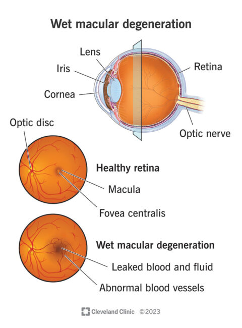 macular degeneration treatment in Buffalo NY